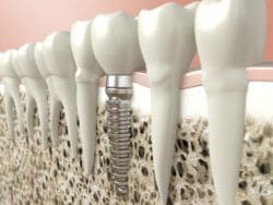 single tooth dental implant in charleston, sc