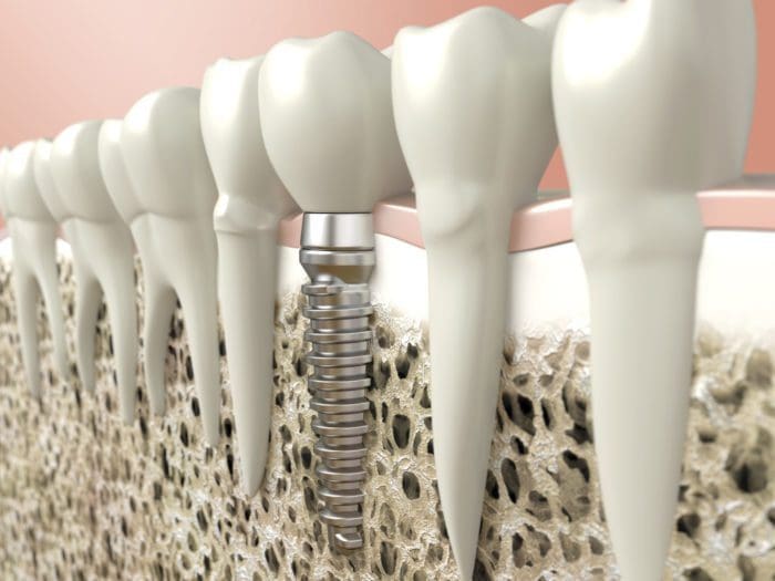 Dental implants in Charleston SC