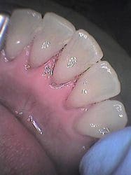 ultrasonic dental cleaning in charleston sc