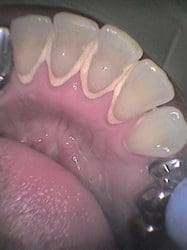 ultrasonic dental cleaning charleston sc