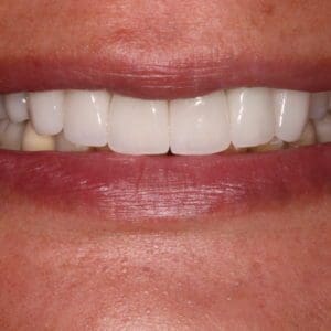 Dinah after full coverage ceramic crowns