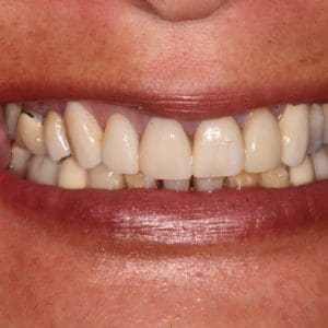 Dinah before full coverage ceramic crowns