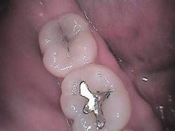 dental fillings charleston sc