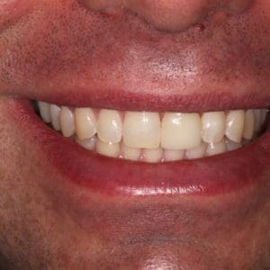 Matt after dental implant in Charleston