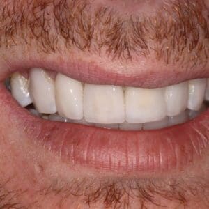 James after smile makeover in Charleston SC
