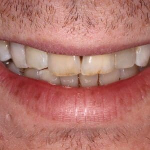 James before smile makeover in Charleston SC