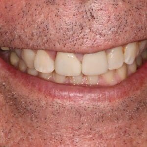 Keith after ceramic crowns in Charleston SC