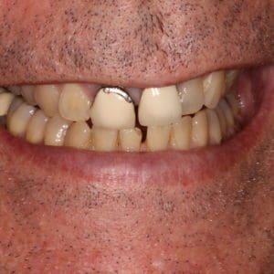 Keith before ceramic crowns in Charleston SC