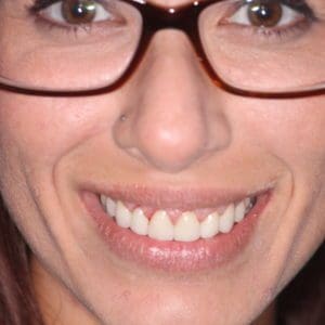Lizza after gum repositioning surgery in Charleston