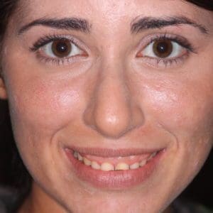 Lizza before gum repositioning surgery in Charleston