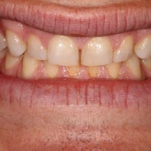 Mikal B before mouth restoration in Charleston SC