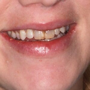 Natalie L before cosmetic dentistry in Charleston SC