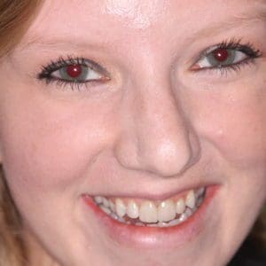 Natalie L after cosmetic dentistry in Charleston SC