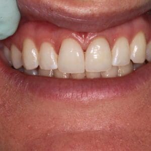 Stephanie G after porcelain veneers