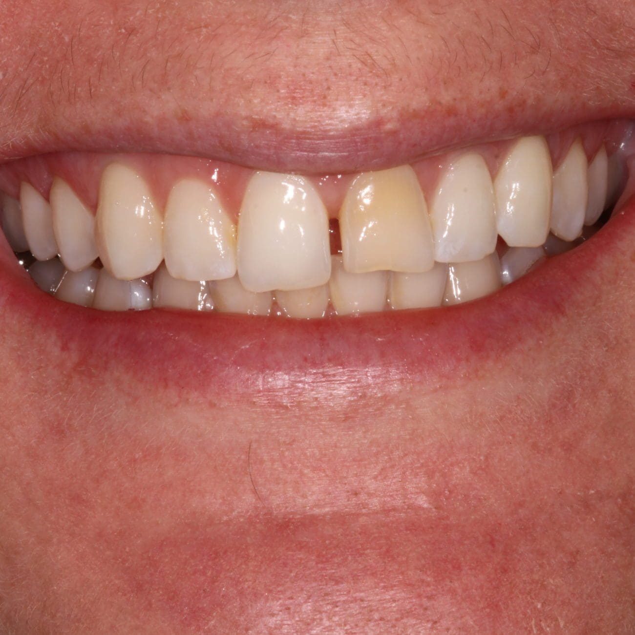 Charleston SC Cosmetic Dentistry Before & After Photos