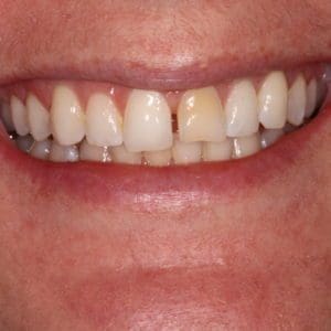 Stephanie G Before porcelain veneers