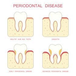 treatment for gum disease in Charleston South Carolina