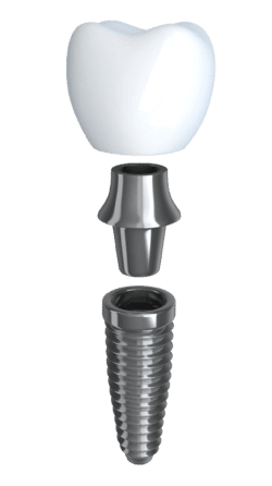 dental implant procedure in charleston, sc