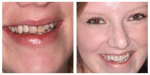 smile makeover patient before and after 3 charleston sc