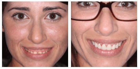 smile makeover patient before and after charleston sc
