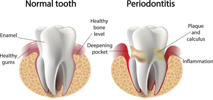 periodontal therapy charleston sc