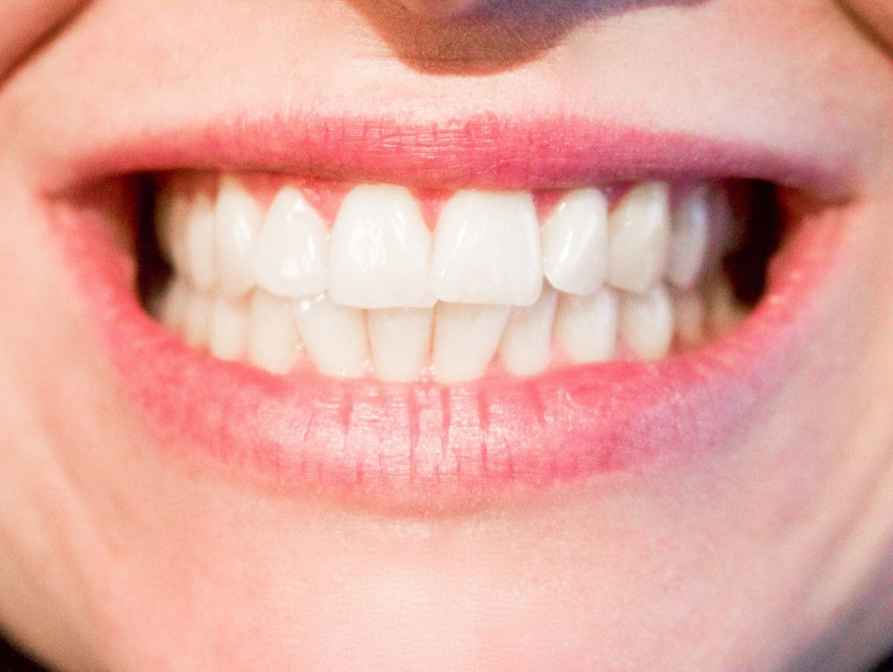 Crooked Teeth Treatment Options | Dentist in Charleston SC