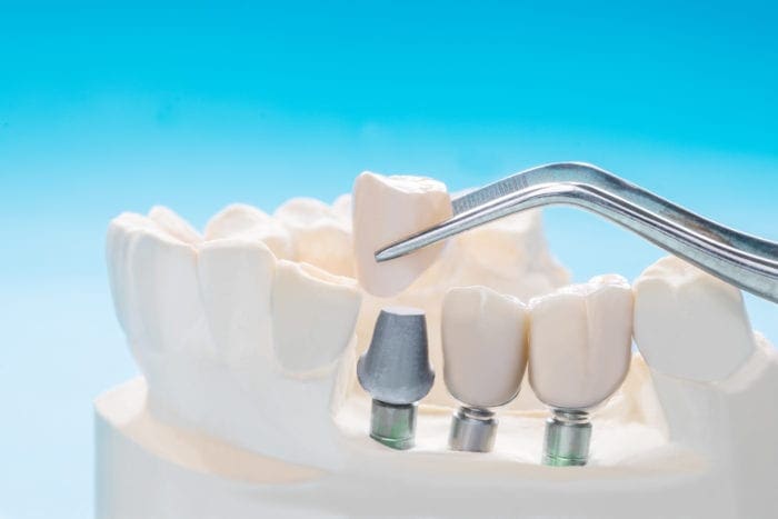 Dental Implants in Charleston, South Carolina