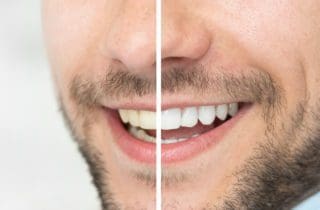 Tooth Discoloration in Charleston, South Carolina