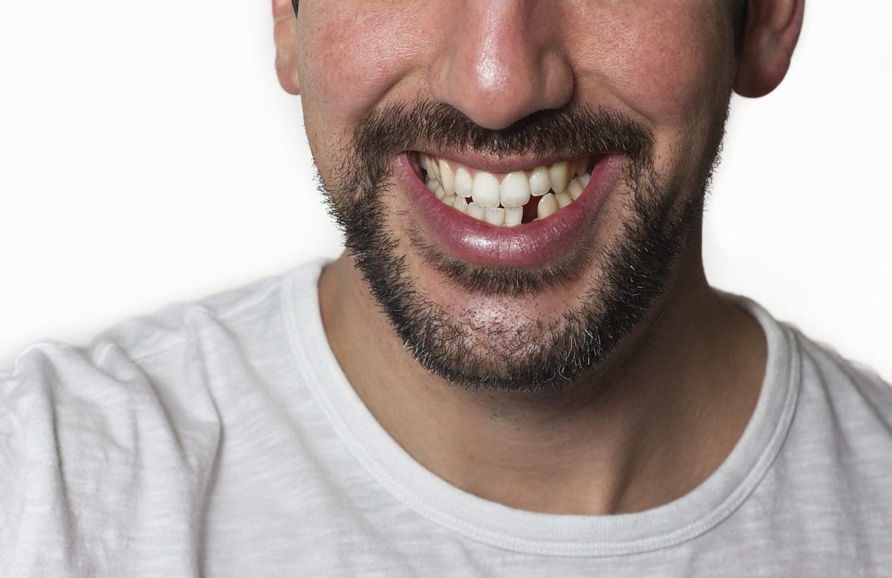 Man smiling with a missing tooth dentist in Charleston North Carolina