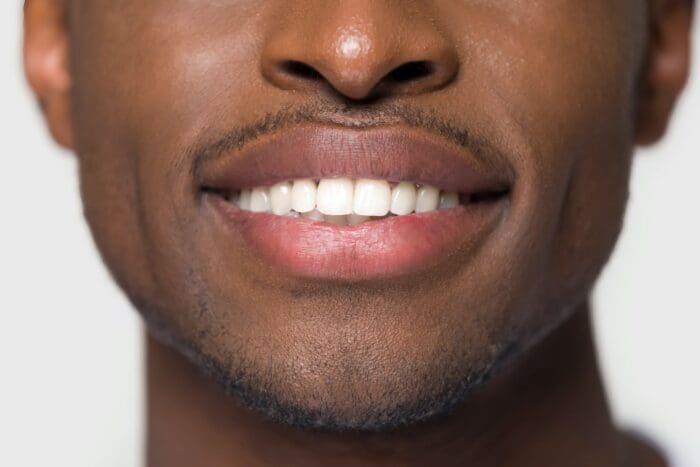 Can Veneers Fix Crooked Teeth?