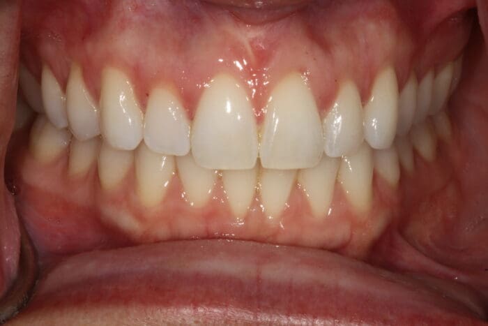 Dental patient after SureSmile clear aligners at West Ashley Family Dentistry
