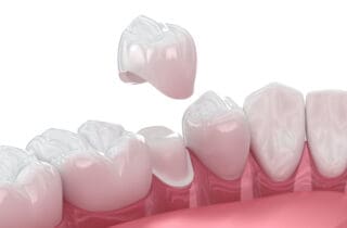 Taking good care of your dental crown not only protects the restoration but also supports the health of the surrounding teeth and gums. 