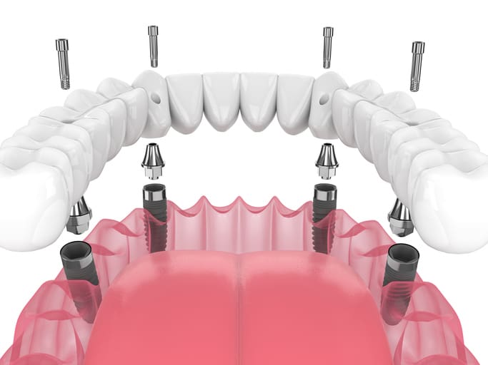 Dental Implant-secured Denture
